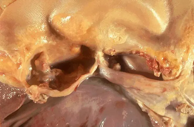 Bicuspid Aortic Valve Disease : 二叶主动脉瓣疾病