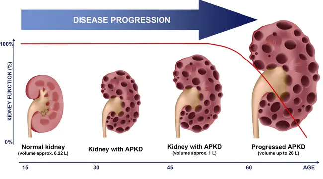 Polycystic Kidney Disease : 多囊肾病