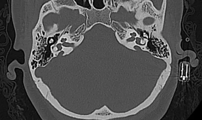 Atypical Rheumatic Syndrome : 非典型风湿综合征