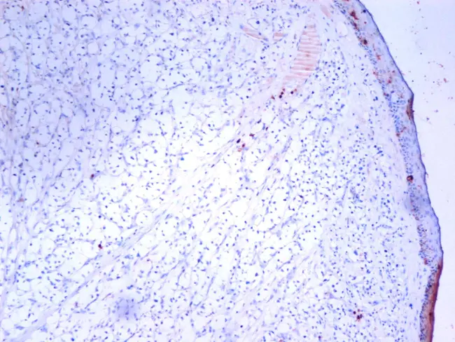 Renal Cell Carcinoma : 肾细胞癌