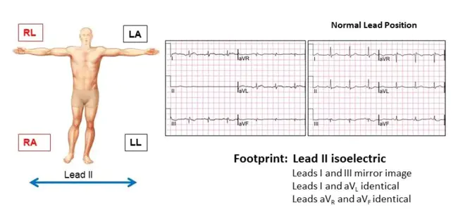 Lead Foot Syndrome : 铅足综合征