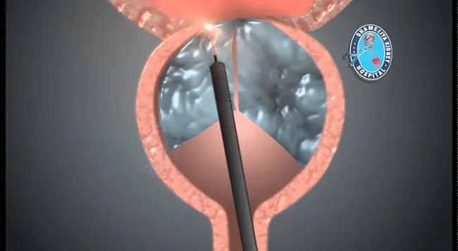 Laser Microbeam Microdissection : 激光微束显微解剖