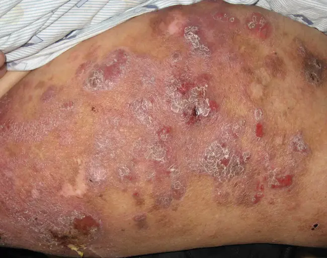 LYmphomatoid Papulosis : 淋巴瘤样丘疹病