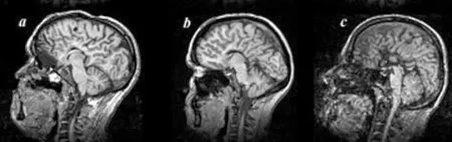 Meckel-Gruber Syndrome : 梅克尔-格鲁伯综合征