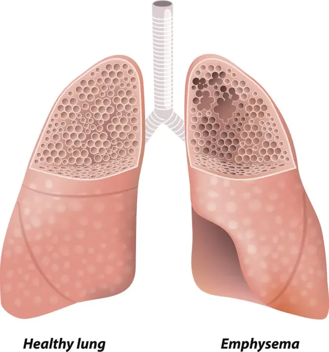 Emphysema Treatment Trial : 肺气肿治疗试验