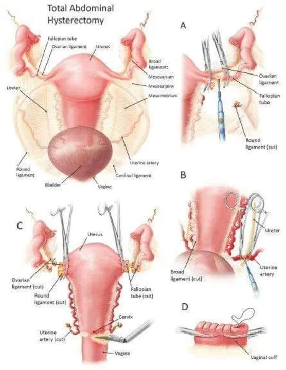 Ovariohysterectomy : 卵巢子宫切除术
