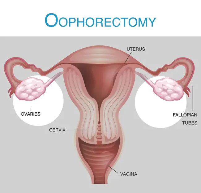 Oophorectomy : 卵巢切除术