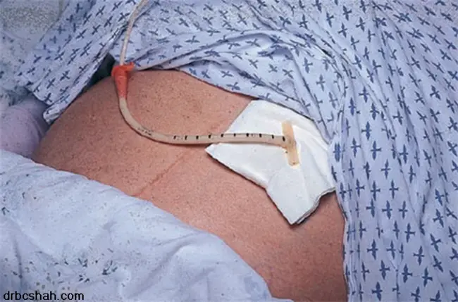 Percutaneous Endoscopic Gastrotomy : 经皮内镜胃切开术