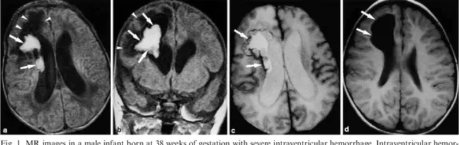 Peri- Ventricular Hemorrhage : 脑室周围出血