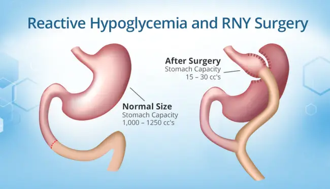 Reactive HypoGlycemia : 反应性低血糖症