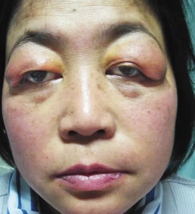 Sjogrens Syndrome : 干燥综合征
