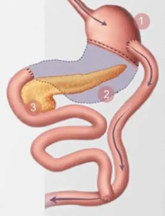 Roux-en-Y Gastric Bypass : 胃旁路术