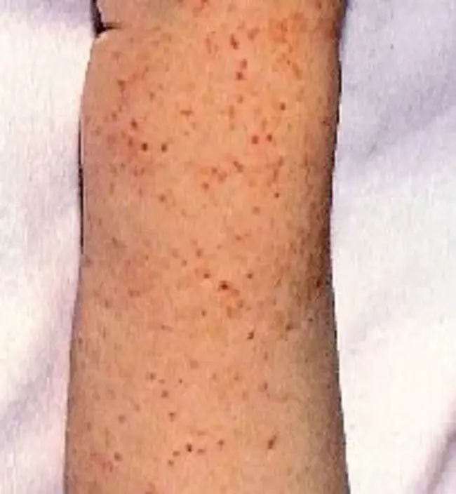 Idiopathic Thrombocytepenia Purpura : 特发性血小板减少性紫癜