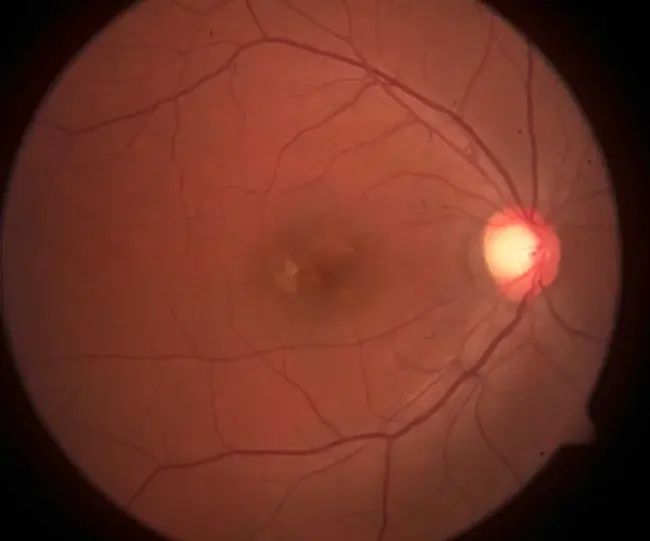 Choroidal Neovascularization : 脉络膜新生血管