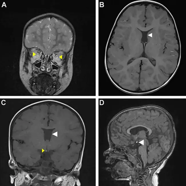 Septo Optic Dysplasia : 视隔发育不良