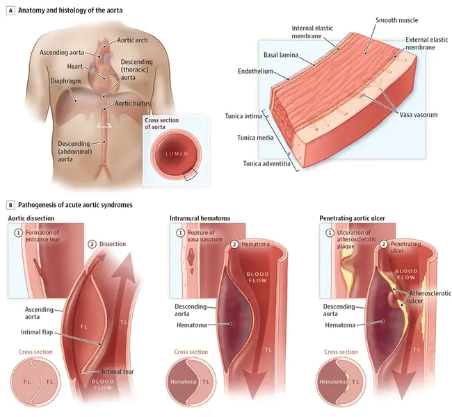 Aortic Aneurysm Repair : 主动脉瘤修复