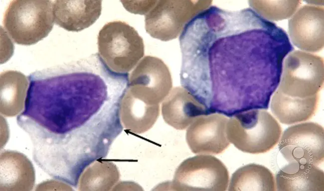 Infectious Haematopoietic Necrosis : 传染性造血坏死