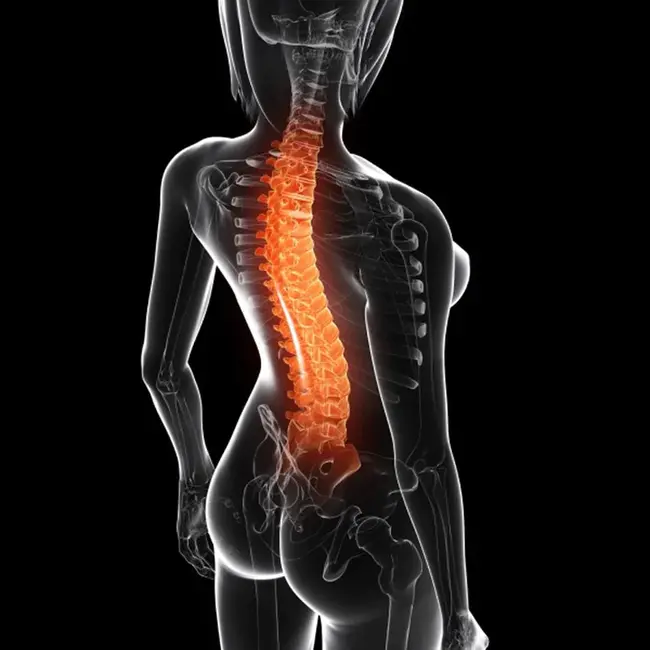 Spinal Muscular Atrophy : 脊髓肌萎缩
