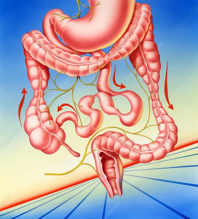 Irritable Bowel : 肠易激