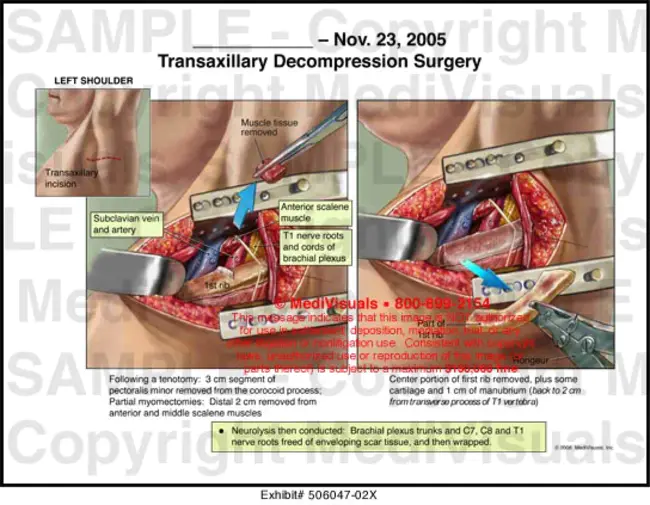 Transaxillary Endoscopic Subpectoral Saline Augmentation : 经腋下内镜下胸膜下盐水扩张术