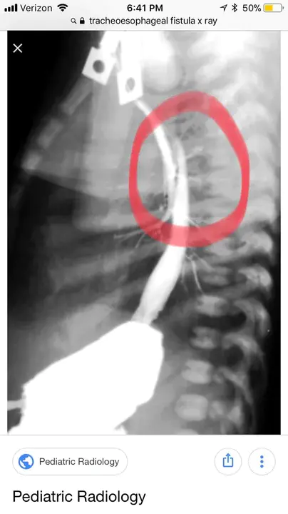 Tracheal Esophageal Fistula : 气管食管瘘