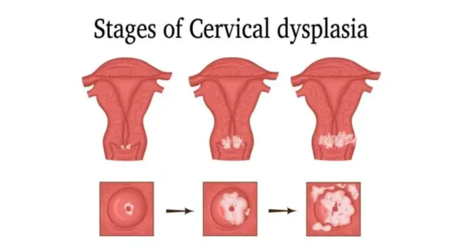 Cervical Interepithelial Neoplasia : 宫颈上皮间瘤样病变