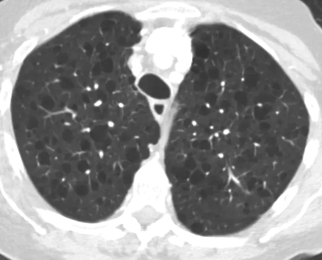 LymphAngioleioMyomatosis : 淋巴管肌瘤病