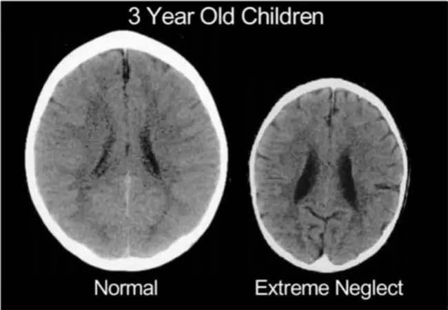 Pediatric Brain Turmor Foundation of the United States : 美国儿科脑肿胀基金会