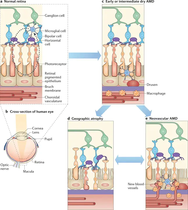 Gradual Retrograde Immune Degeneration : 渐进性逆行免疫变性