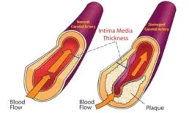 Intimal-Medial Thickness : 内膜中厚