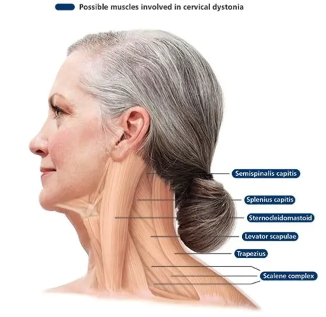 Dystonia Medical Research Foundation : 肌张力障碍医疗研究基金会