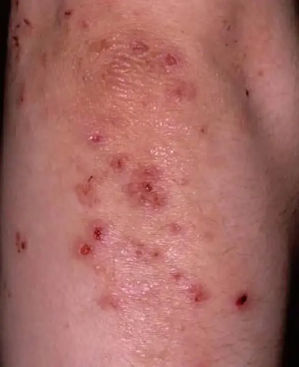 Dermatitis Herpetiformis : 疱疹性皮炎