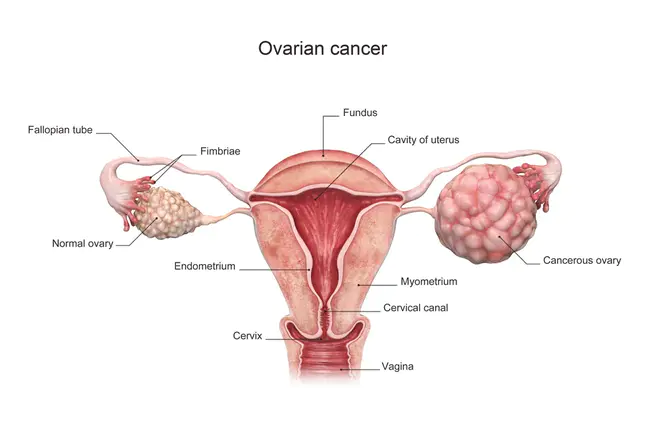 Ovarian Cancer National Alliance : 卵巢癌全国联盟