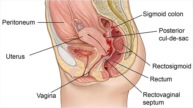 Endometriosis Association : 子宫内膜异位症协会