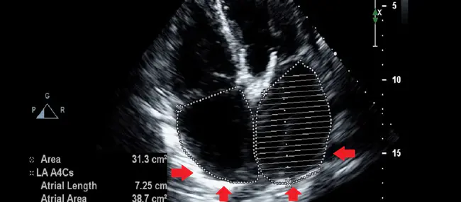 Transthoracic Needle Biopsy : 经胸穿刺活检