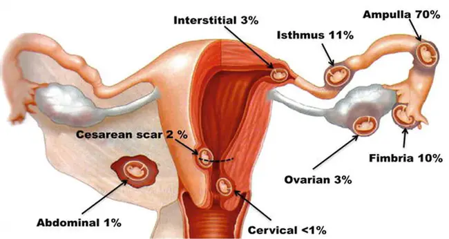 Interstitial Cystitis Association Update : 间质性膀胱炎协会更新