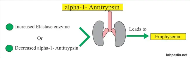 Alpha-1 Antitrypsin Deficiency : Alpha-1 抗胰蛋白酶缺乏症