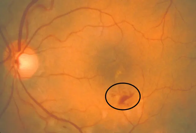 Retinal Ablation Gene : 视网膜消融基因