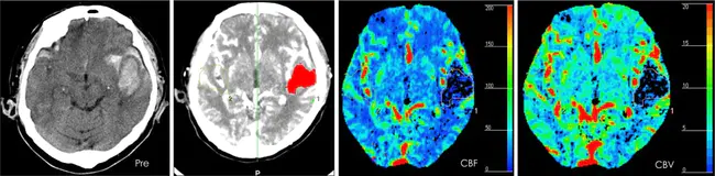 Cortical Vision Impairment : 皮质视觉障碍