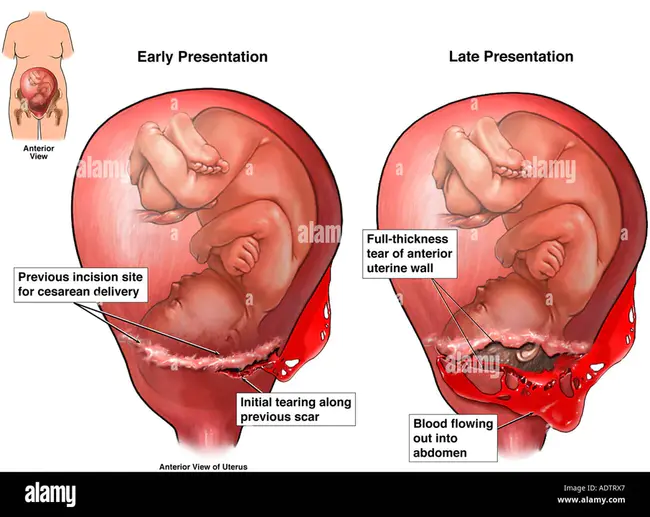 Uterine Epithelial Height : 子宫上皮高度