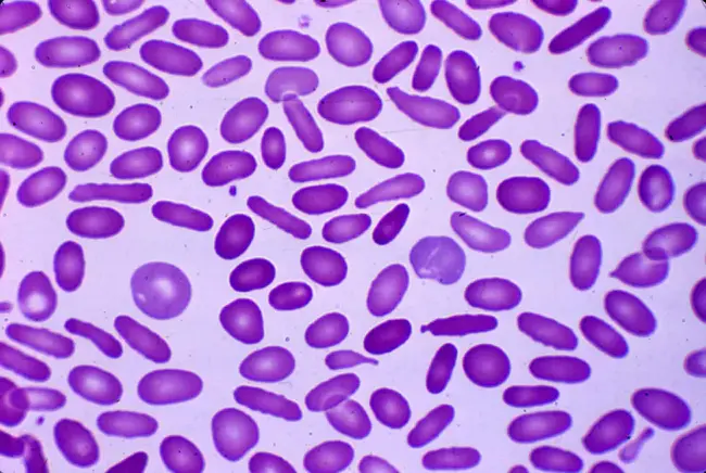 Hereditary Hemochromatosis : 遗传性血色素沉着病