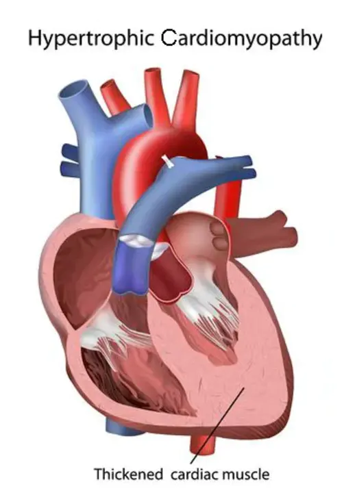 Hypertrophic Cardiomyopathy : 肥厚性心肌病