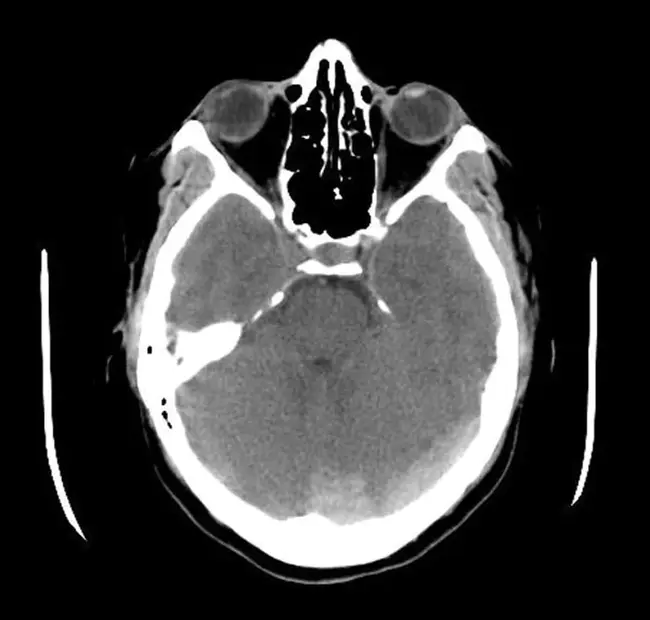 Venous ThromboEmbolism : 静脉血栓栓塞