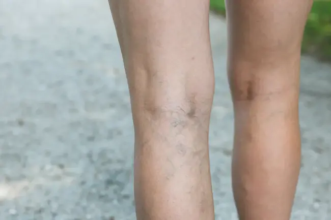 Varicose Veins Questionnaire : 静脉曲张问卷