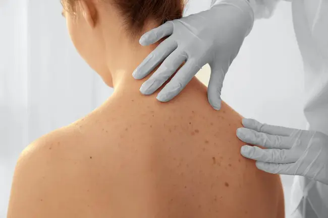 Skin Cancer Awareness Requires Education : 皮肤癌意识需要教育