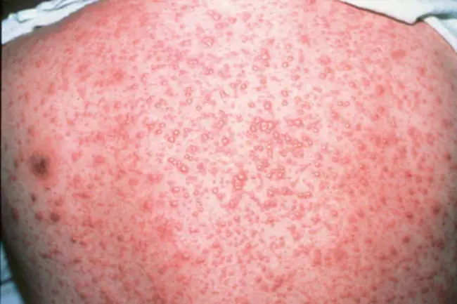 Varicella Zoster Infection : 水痘带状疱疹感染