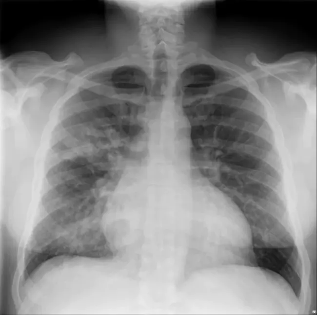 Bronchial Obliterans : 支气管闭塞