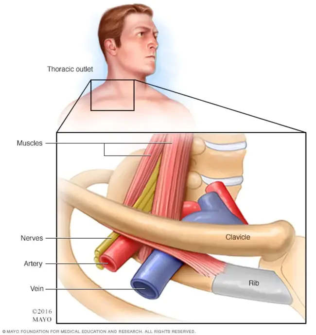 Thoracic Lumbar Sacral Orthotic : 胸腰椎骶骨矫形器