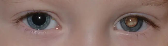 Retinoblastoma By : 视网膜母细胞瘤