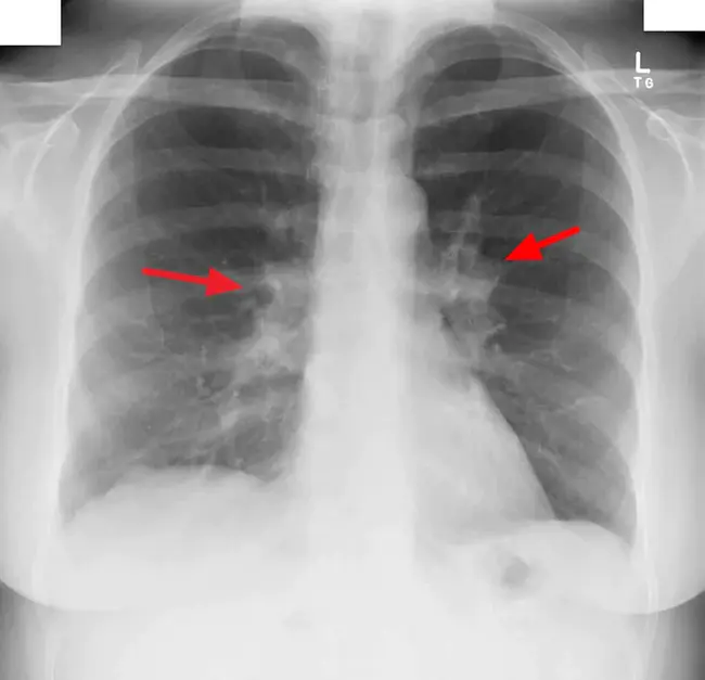 Bilateral Salpingo Oopherectomy : 双侧输卵管卵球切除术